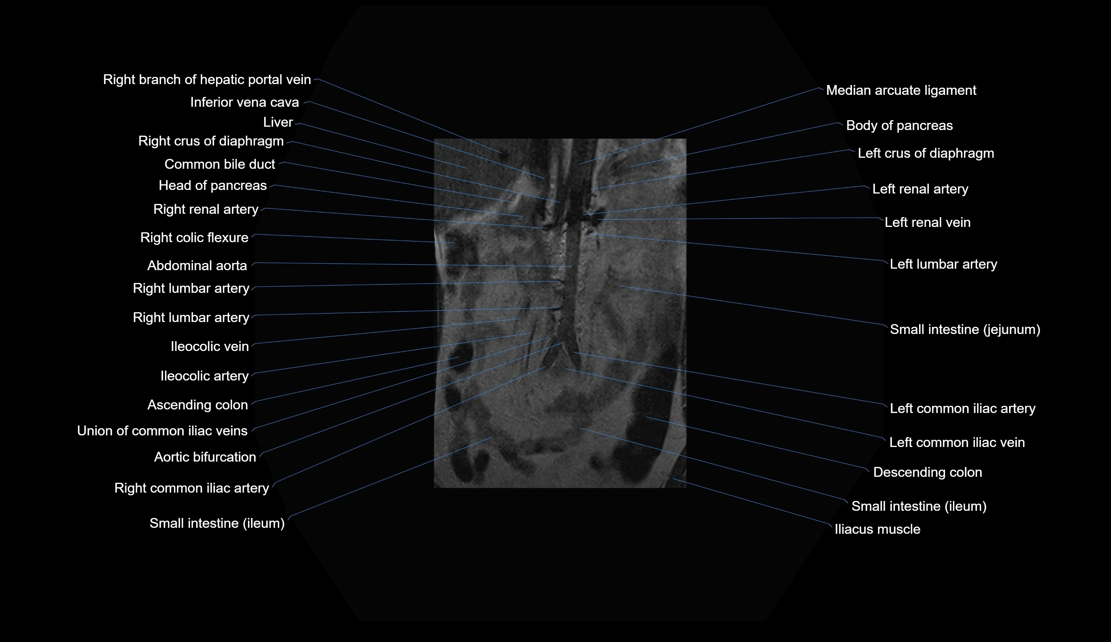 MRI lumbar spine coronal cross sectional anatomy 3T radiology  image-img-00001-00002.webp
